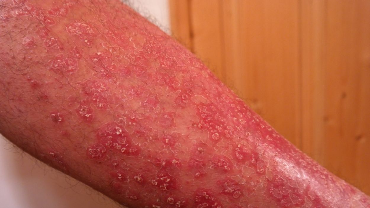 Psoriasi: Una malaltia no contagiosa encara molt desconeguda