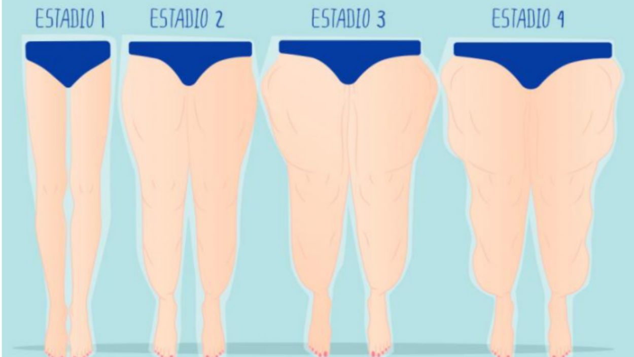 Tens les cames desproporcionadament inflades? Potser tens lipedema sense diagnosticar