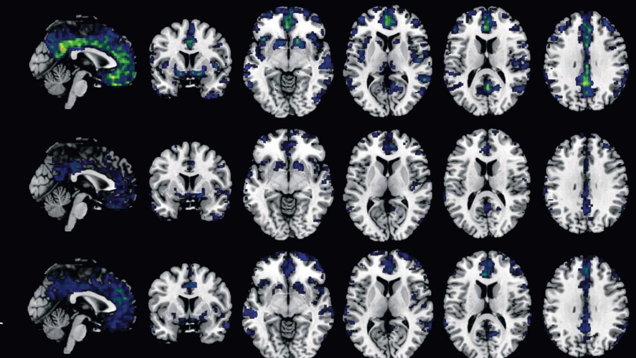 Les dones amb Alzheimer tenen més probabilitat de patir símptomes neuropsiquiàtrics, segons un estudi