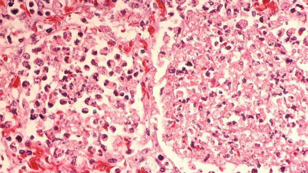 Detectat un brot de legionel·losi
 a Sant Cugat