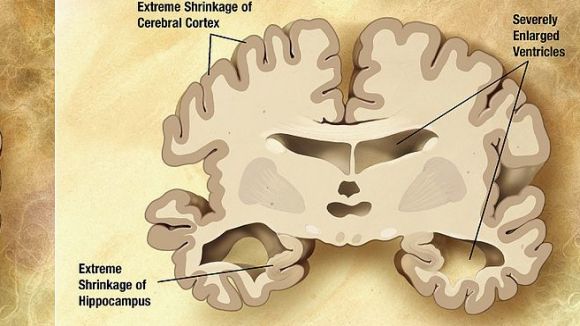 'El Pou' descobreix l'aducanumab, un medicament que podria ser efectiu en les primeres fases de l'Alzheimer