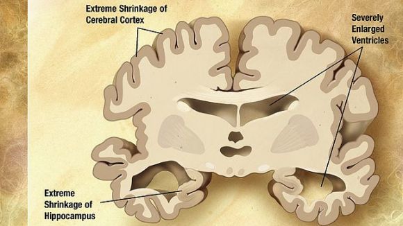 Alt: Sant Cugat commemora el Dia Mudial de Alzheimer amb actes informatius
