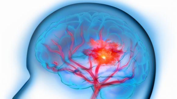 Sant Cugat commemora el Dia de l'Ictus amb una xerrada de sensibilització